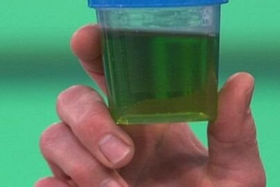 Green Urine Causes, Concerns, and When to Seek Medical Attention