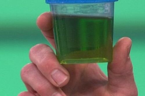 Green Urine Causes, Concerns, and When to Seek Medical Attention