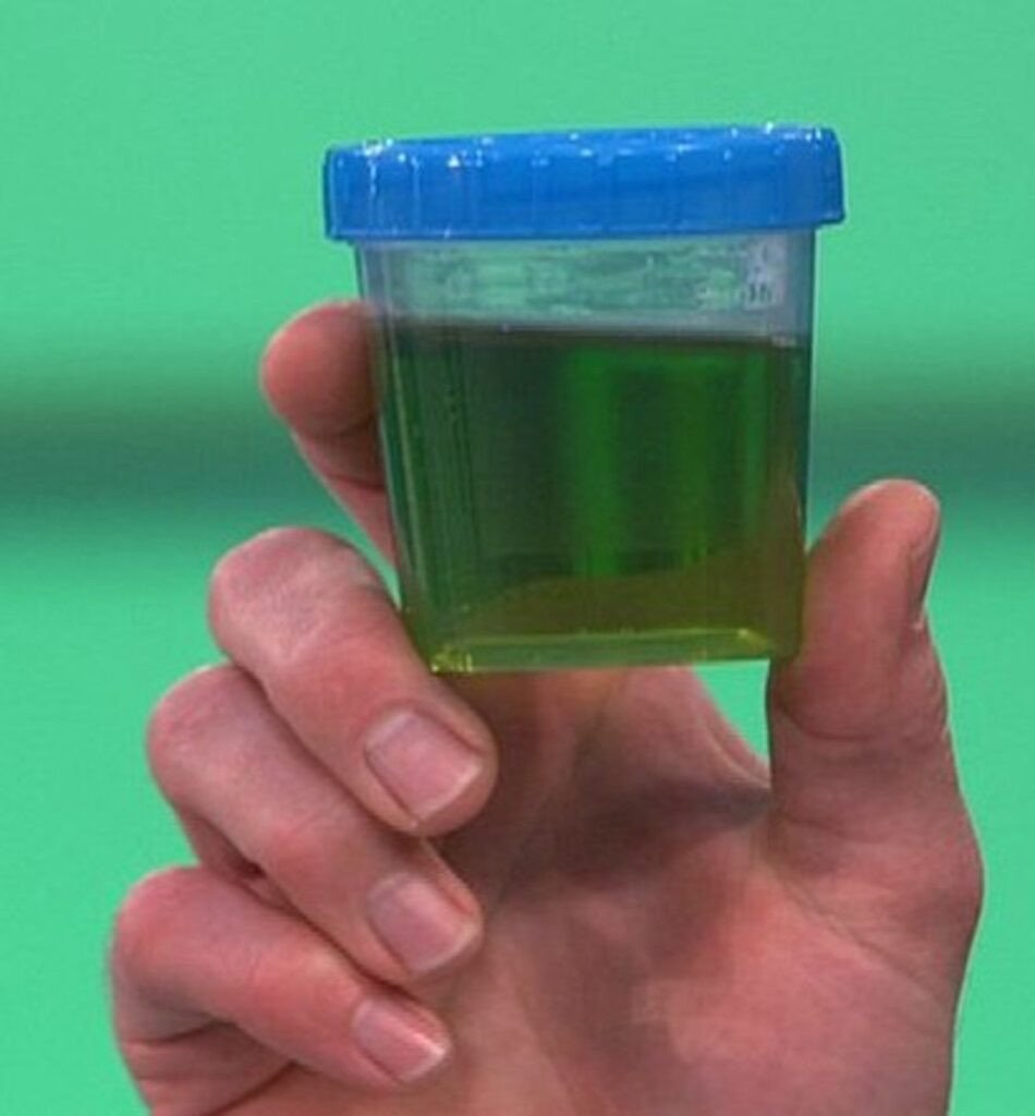 Green Urine Causes, Concerns, and When to Seek Medical Attention