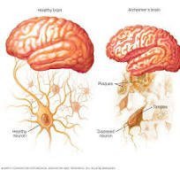 "The Ultimate Guide to Understanding Alzheimer’s Disease: Symptoms, Stages & Treatment"