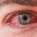 "What Does Pink Eye Look Like? Signs, Symptoms, and Pictures"