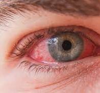 "What Does Pink Eye Look Like? Signs, Symptoms, and Pictures"